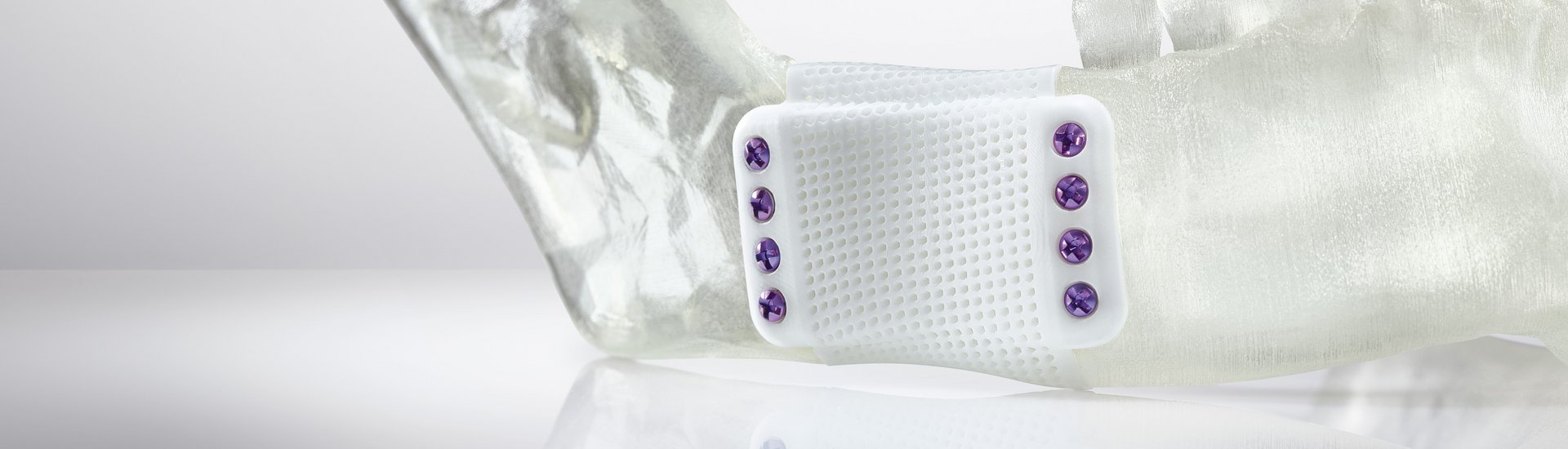 Additiv gefertigtes keramisches Kieferimplantat 